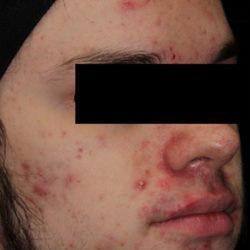 AviClear Before & After Patient #1668